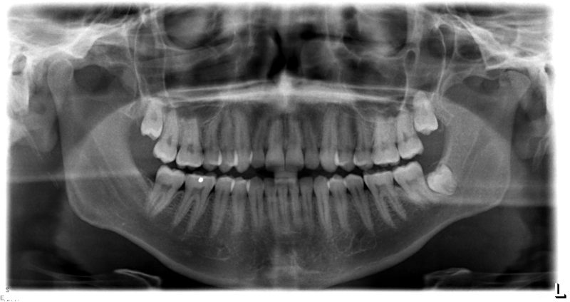A full panoramic dental X-ray showing upper and lower adult teeth, jaw structure, and roots.